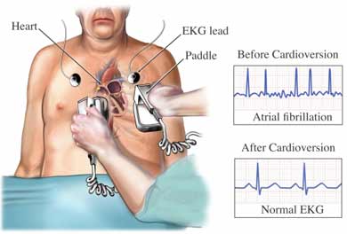 Cardioversion