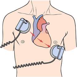 Defibrillation