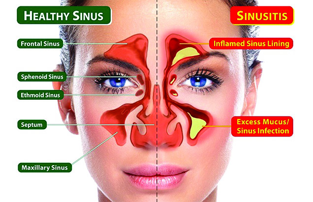 Sinus Areas and Sinustis