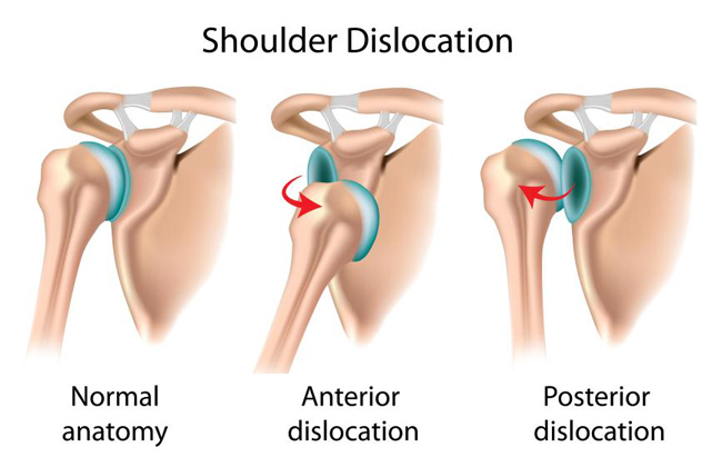 Dislocated Shoulder