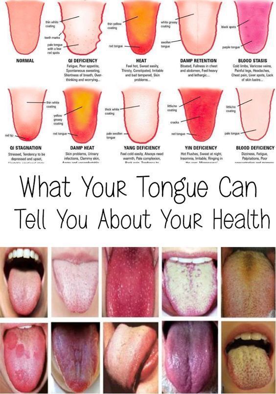 Tongue Health Warning Signs